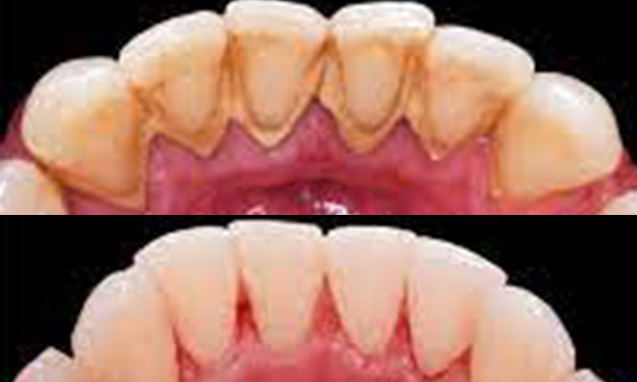 Tooth Cleaning Scaling