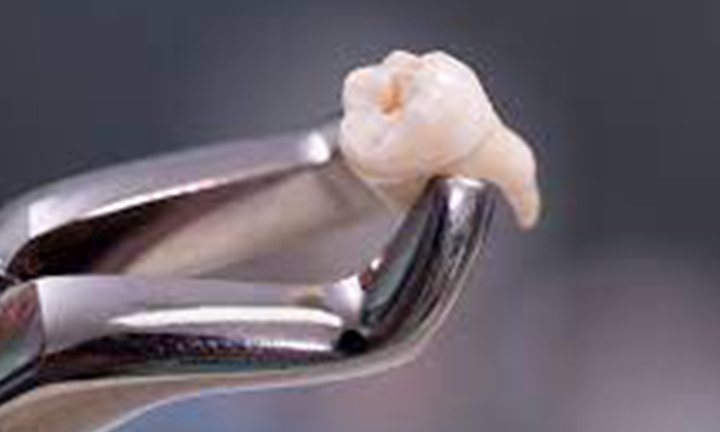 Tooth Extraction