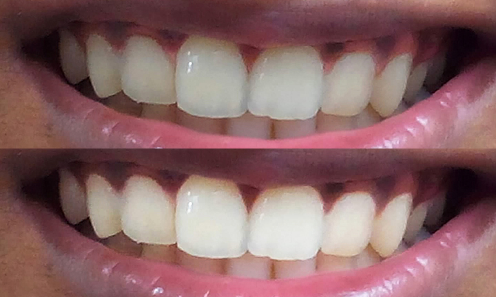 Tooth Whitening